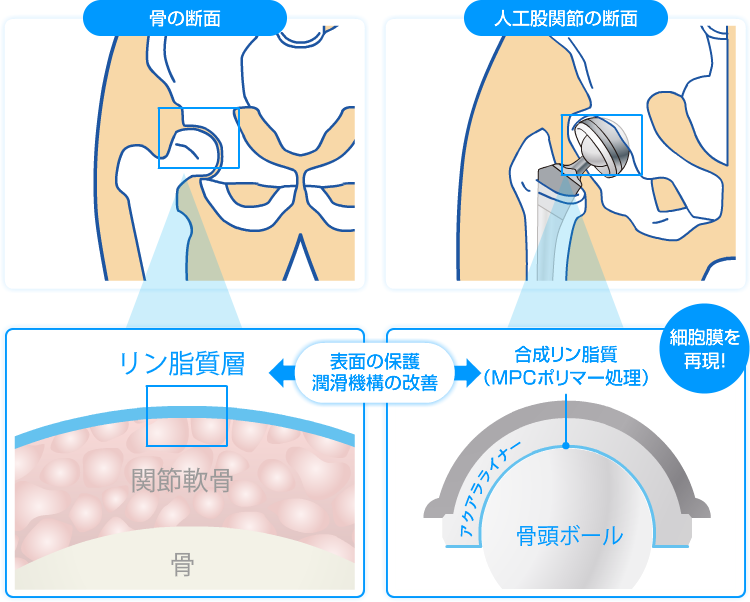 図：骨の断面、人工股関節の断面