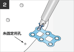 図:SKULPIO側にプレートを長さ4.5mmのスクリューを用いて手回しで固定します。