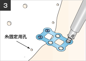 図:母床骨側には長さ4.0mmのスクリューを用いて固定します。