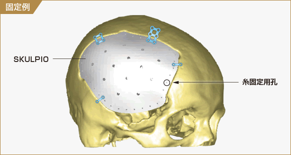 図:SKULPIO固定例