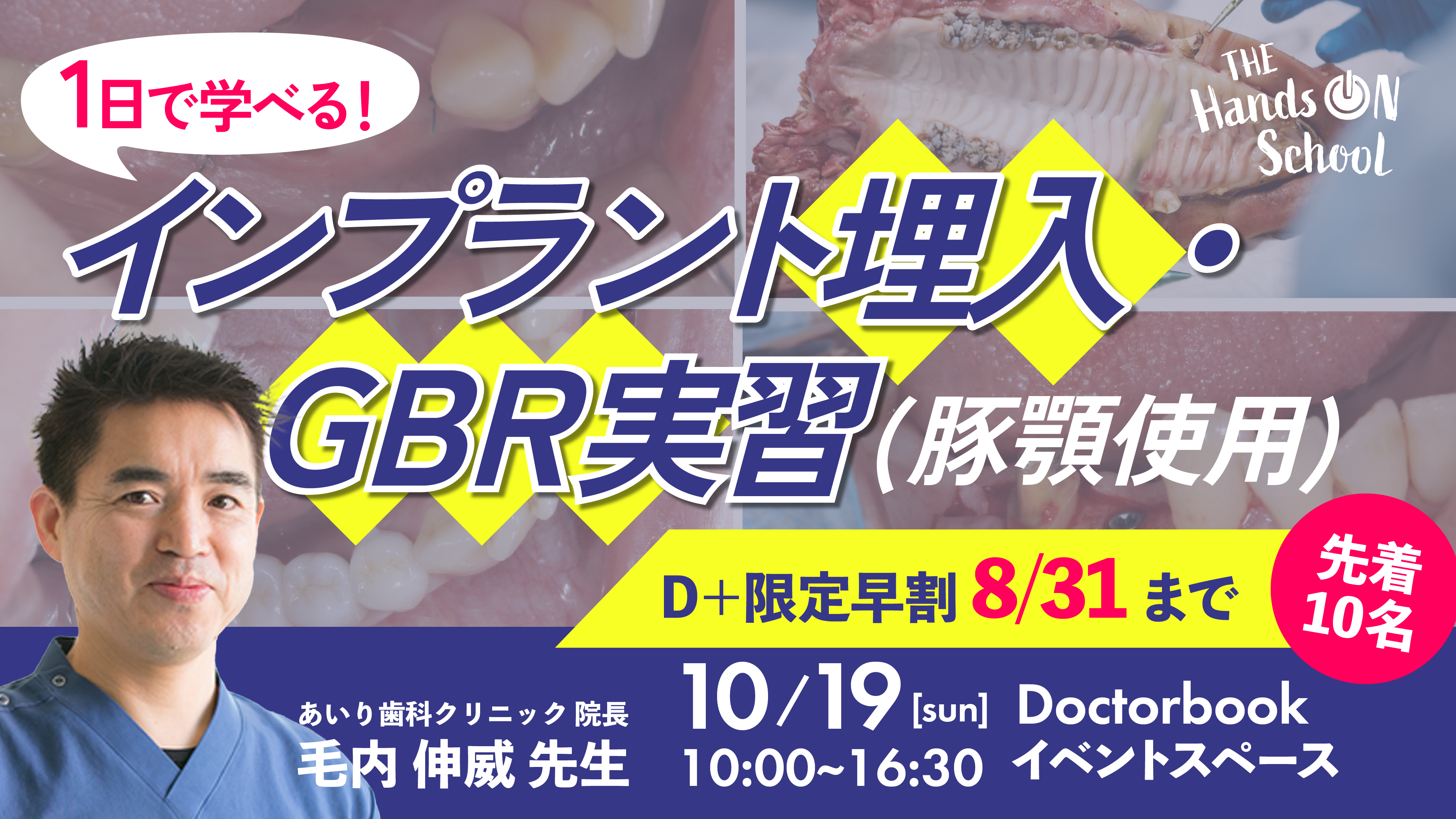 【ハンズオン】【講師： 毛内 伸威 先生】1日で学べるインプラント埋入・GBR実習（豚顎使用）